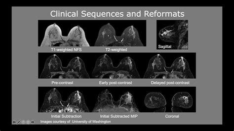 New Update Breast Mri Youtube