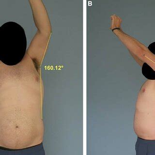 Video measurement of active range of motion of shoulder flexion and ...