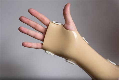 Metacarpal Fracture Treatment Ladan Hajipour Manchester