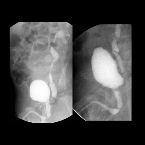 posterior urethral valve | pacs