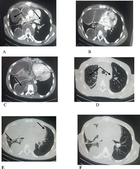 Figure From A Case Report Of Extra Pulmonary Tuberculosis Presenting