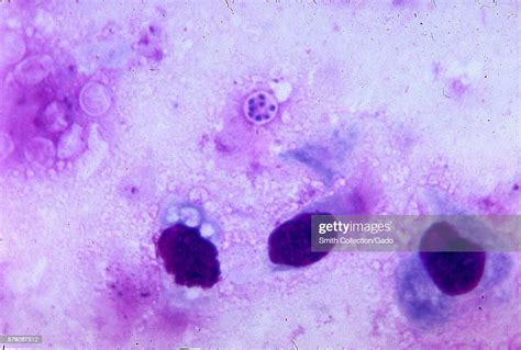 Pneumocystis Jirovecii Formerly Known As Pneumocystis Carinii Is News Photo Getty Images