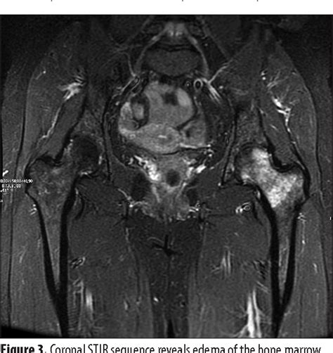 Evaluation Of Transient Osteoporosis Of The Hip In Magnetic Resonance