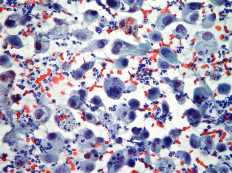 Thyroid Cytopathology Cellnetpathology