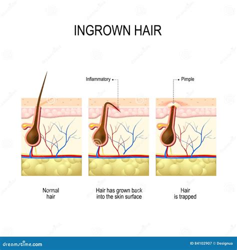 Ingrown Hair after Hair Removal and Shaving Stock Vector - Illustration of hygiene, healthcare ...