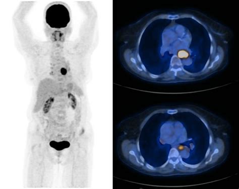 Value Of A 18F FDG PET CT Semi Quantitative Parameter SUVmax In