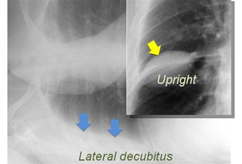 Thoracentesis Best Practices Slideshow