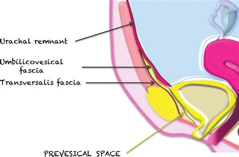 Mri Of Tumors And Tumor Mimics In The Female Pelvis Anatomic Pelvic Space Based Approach