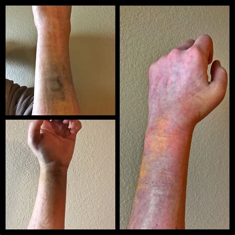 Fractured Wrist Bruising