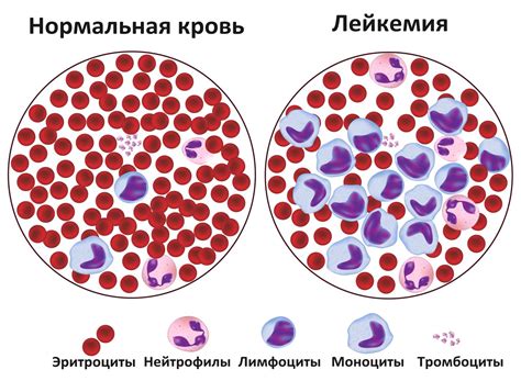 Лейкемия или лейкоз рак крови острый симптомы лечение