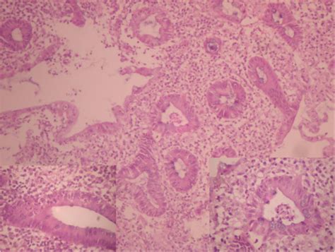 Photomicrograph Of Uc Rectal Mucosa Showing Intense Inflammation With Download Scientific