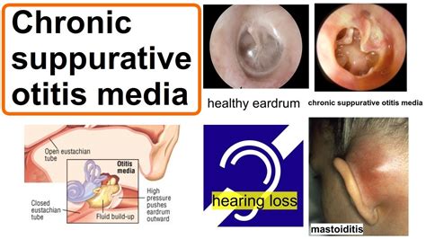 Ent Stud Ent Intra Temporal Complications Of Facebook Off