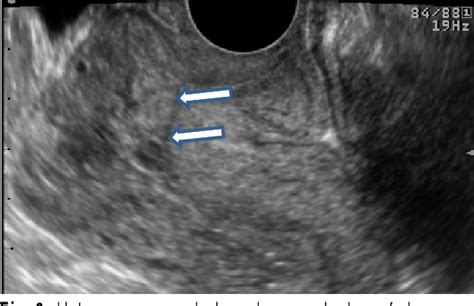 Figure 2 From The Prenatal Sonographic Diagnosis Of Placental Adhesion