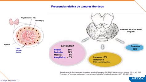 Mehu U T C Ncer De Tiroides Ppt