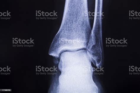 X Ray Of Bone Stock Photo - Download Image Now - Anatomy, Ankle, Black ...