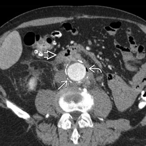 Aortoenteric Fistula Radiology Key