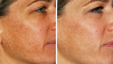 Hyperpigmentation Treatment Results