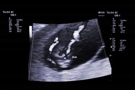 430+ Ultrasound Twins Stock Photos, Pictures & Royalty-Free Images - iStock