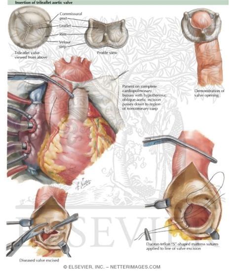 Insertion of Trileaflet Aortic Valve