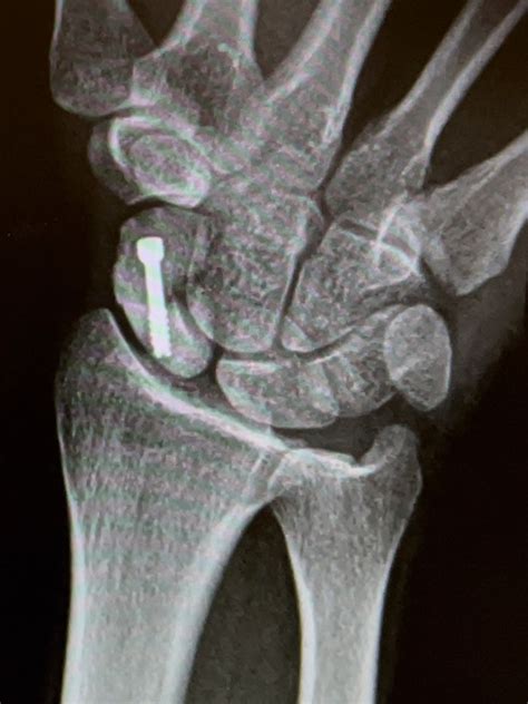 Scaphoid Fracture Surgery