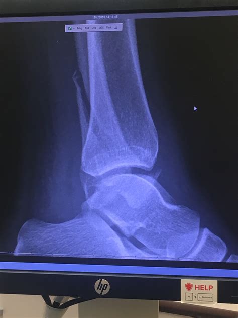 fibula fracture – Broken Ankle Club