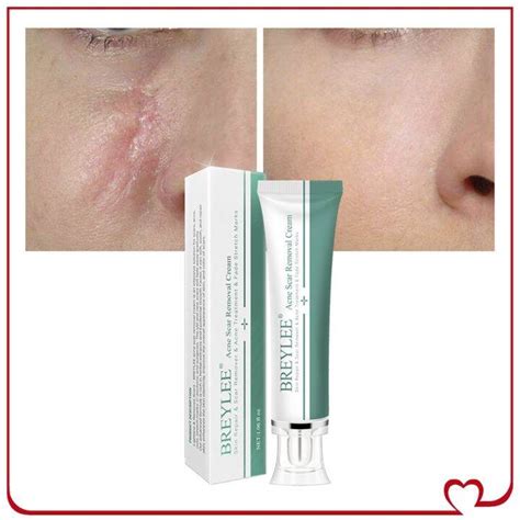 Hot Trending Breylee Acne Scar Removal Cream Face Cream Repair Skin