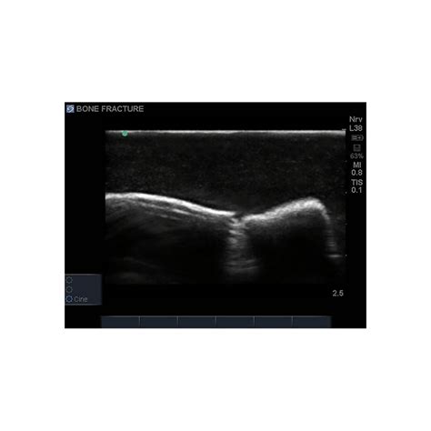 Bone Fracture Ultrasound Training Block