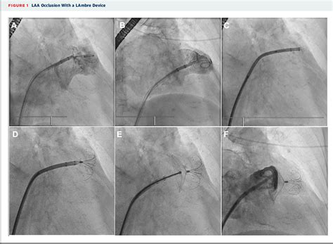 Figure 1 From Percutaneous Closure Of Left Atrial Appendage With