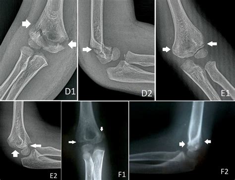 Continued D1 Anteroposterior And D2 Lateral Radiographs Of Patient