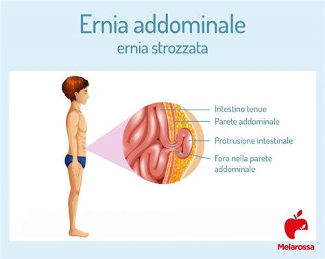 Ernia Addominale Che Cos Sintomi E Cause Rimedi