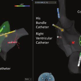 Electroanatomic Map In A Patient Undergoing Left Ventricular