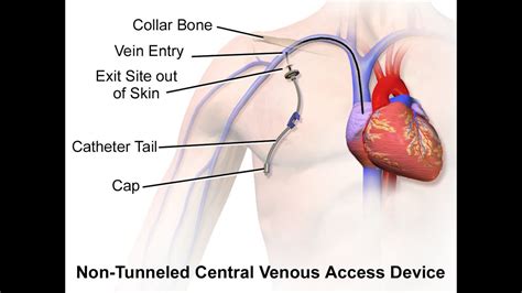 Central Venous Catheter Cpt Code Simplify Medical Coding Youtube