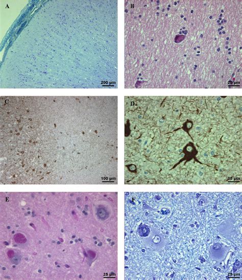 Cytoarchitectural Abnormalities In Different Histological Types Of Fcd