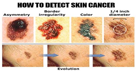 Skin Cancer Signs And Symptoms