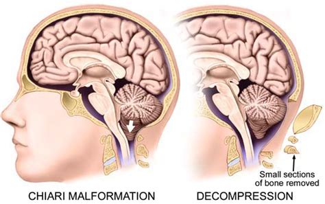 Dr Arun Lnaik Chiari Malformation