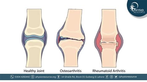 Osteoarthritis Vs Rheumatoid Arthritis