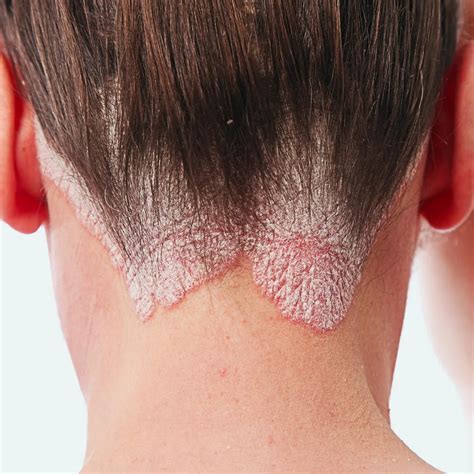 Common Scalp Problems Dr Wang Yi Shi W Skin And Laser Clinic