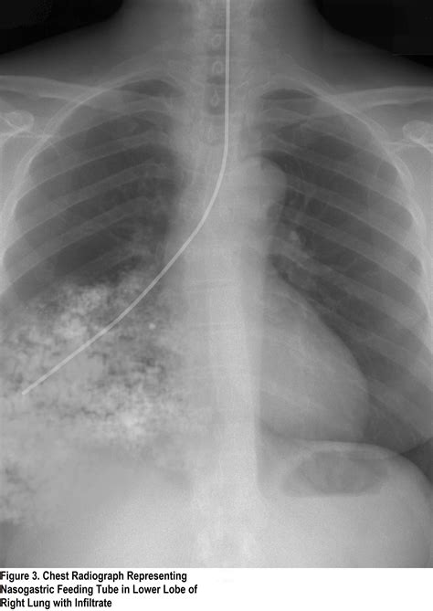 Nasogastric Ng Tube Placement Oxford Medical Education