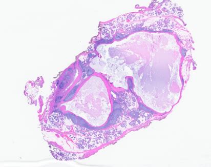 Case 1104 - A Female in Her Early 50s With a Parotid Mass | Department ...