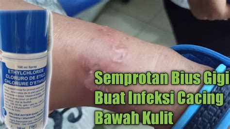 Obat Semprotan Gigi Ini Bisa Juga Untuk Infeksi Parasit Cacing Bawah