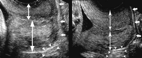 Ultrasound Evaluation Of The Cervix Radiology Key