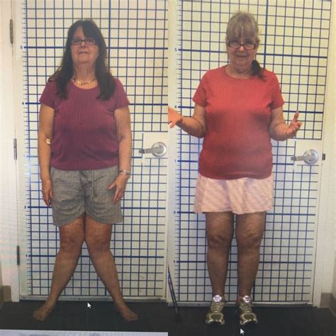 Knock Knee Before And After Limb Lengthening Knock Knees Knee Fat Knock Knees Correction