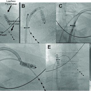 Retrieval Of The Leadless Pacemaker LP Using The Needle S Eye Snare