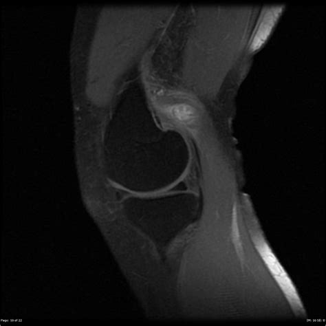 Partial gastrocnemius tear | Image | Radiopaedia.org