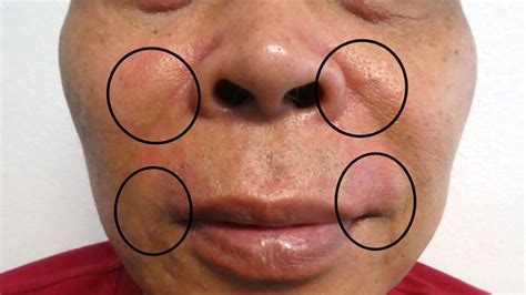 Perioral Dermatitis Causes Symptoms Treatment Prevention