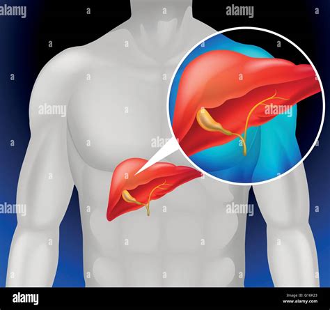 Liver Cancer Diagram In Detail Illustration Stock Vector Image And Art Alamy