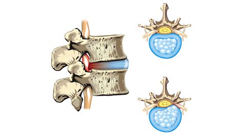 Intervertebral Disc Disease: Causes and Symptoms