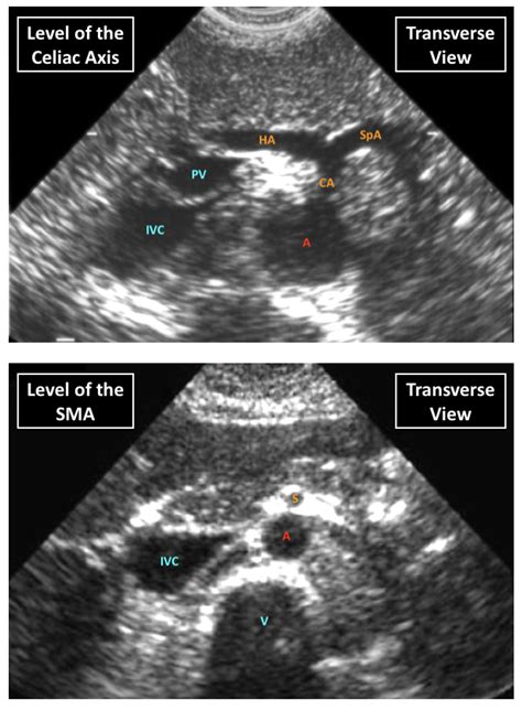 Ultrasound Of The Abdominal Aorta | EMcyclopedia