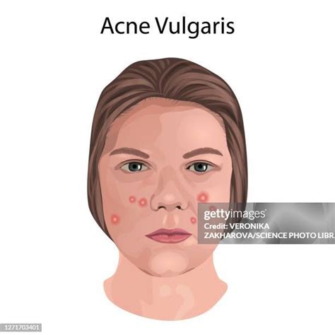 Acne Illustration Photos And Premium High Res Pictures Getty Images