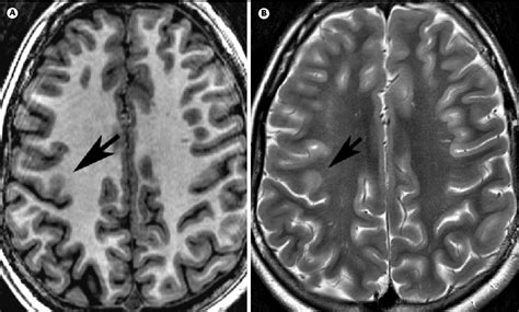 John Libbey Eurotext Epilepsies Malformations Corticales Et